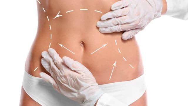 Liposuccion ventre ou abdominoplastie