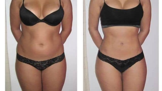 Liposuccion ventre ou abdominoplastie