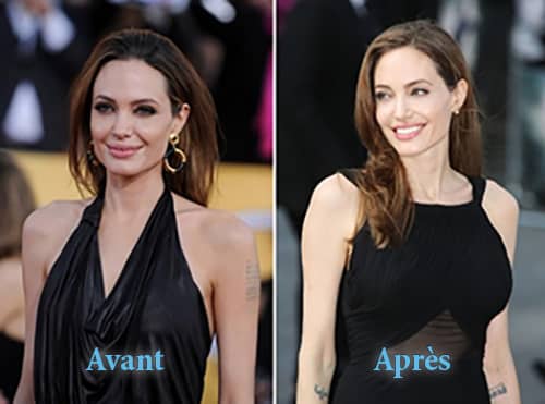 Angeline jolie-implants-mammaire-avant-après