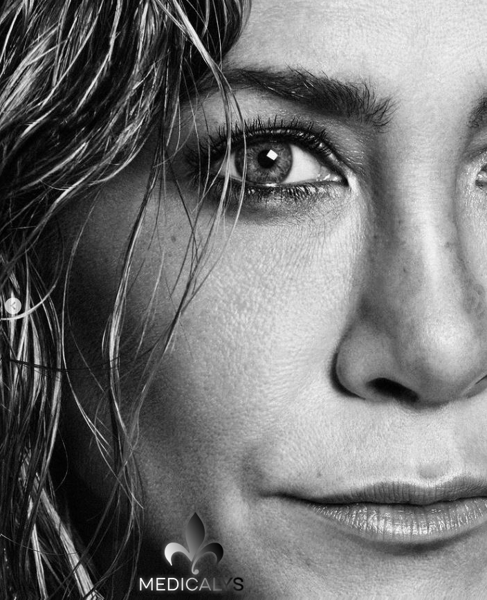 Jennifer Aniston avant/après la chirurgie esthétique