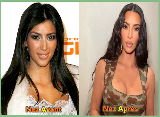 Kim Kardashian après chirurgie esthétique