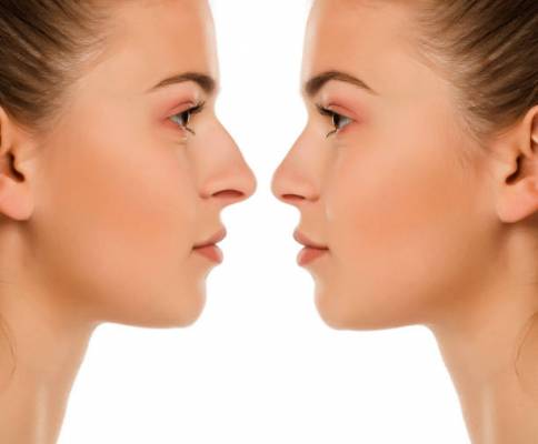 Rhinoplastie_Opération qui peut vous changer la vie