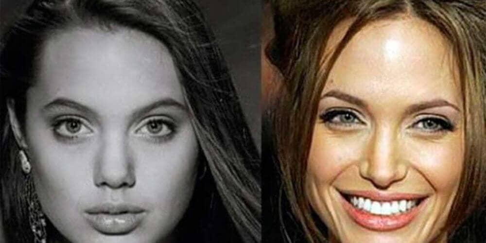 angelina jolie chirurgie esthetique 