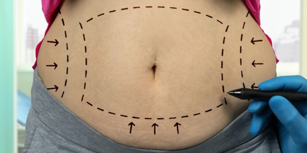 diastasis abdominal