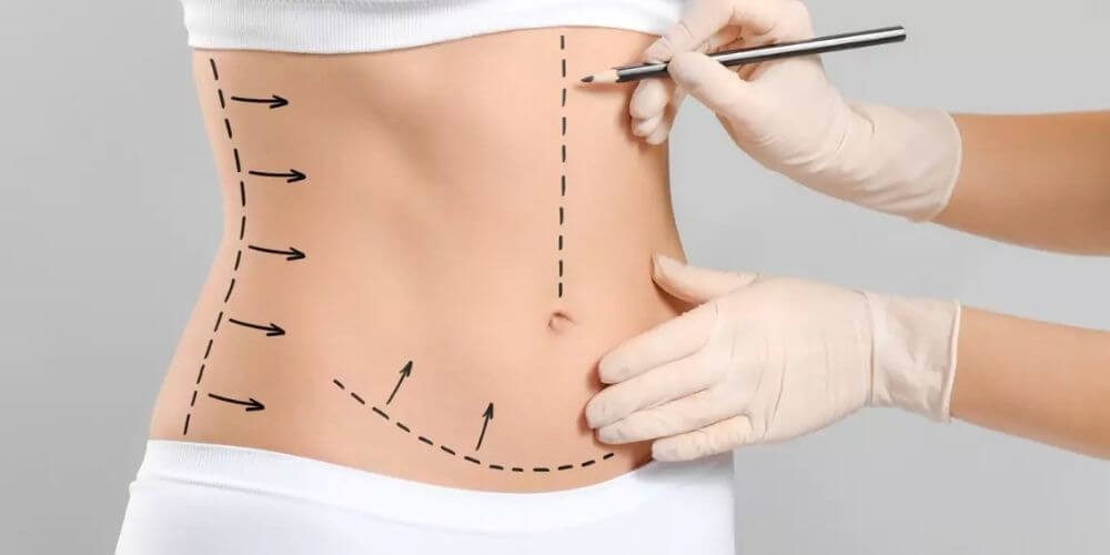 lipoaspiration