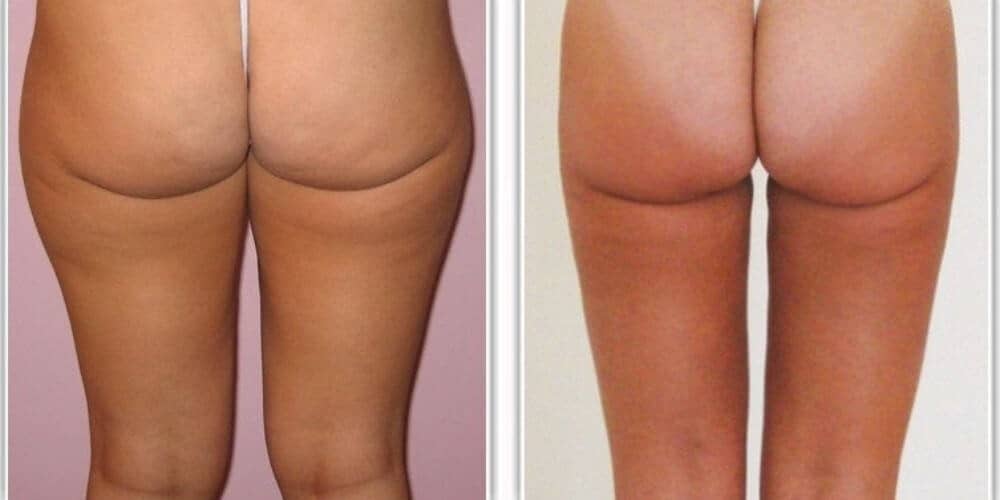 liposuccion cuisses culotte cheval